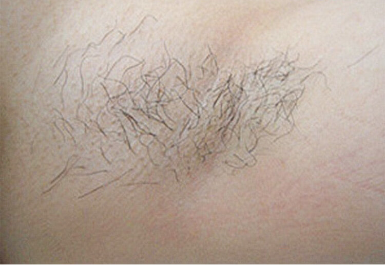 ワキ脱毛の症例写真・女性（施術前）