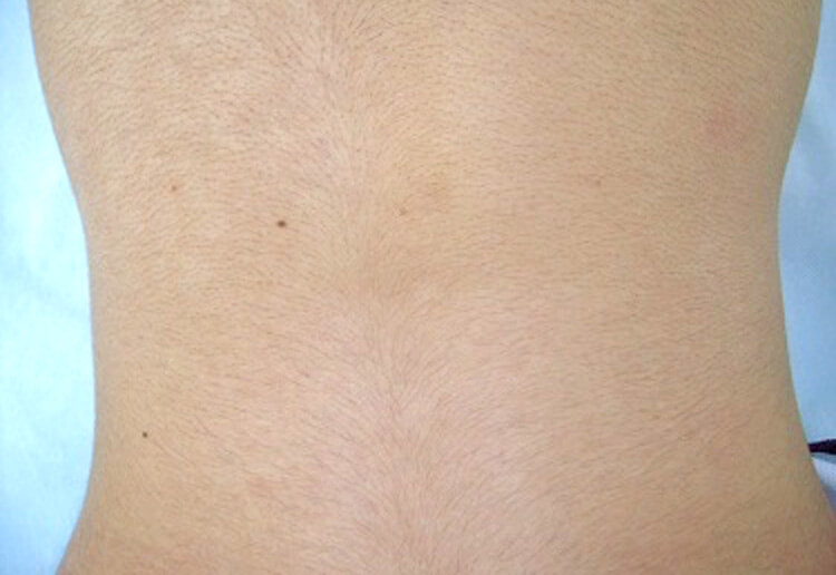 背中脱毛（下部）の症例写真３・20代女性（施術前）