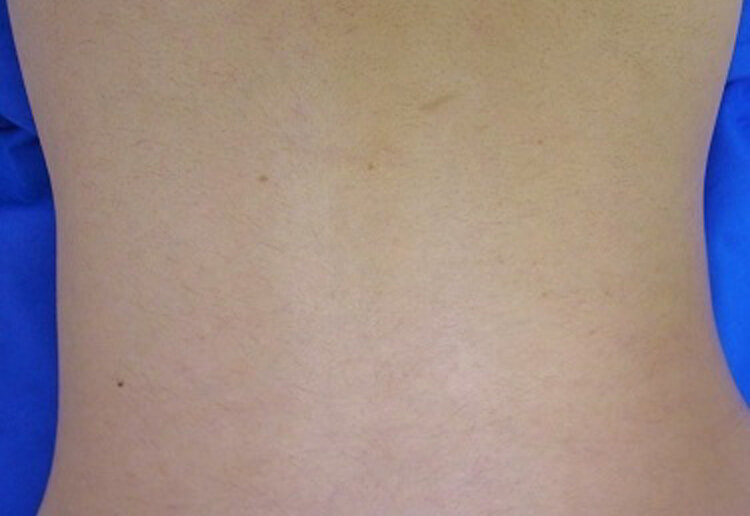 背中脱毛（下部）の症例写真４・20代女性（施術後）