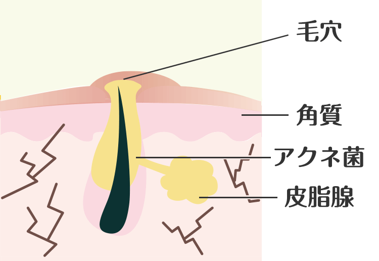 原因①：肌の角化