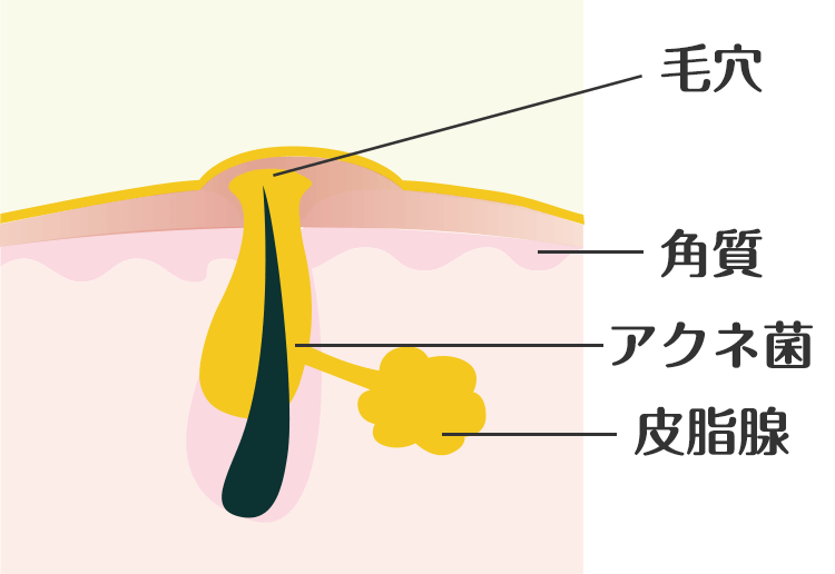 原因②:皮脂の過剰分泌