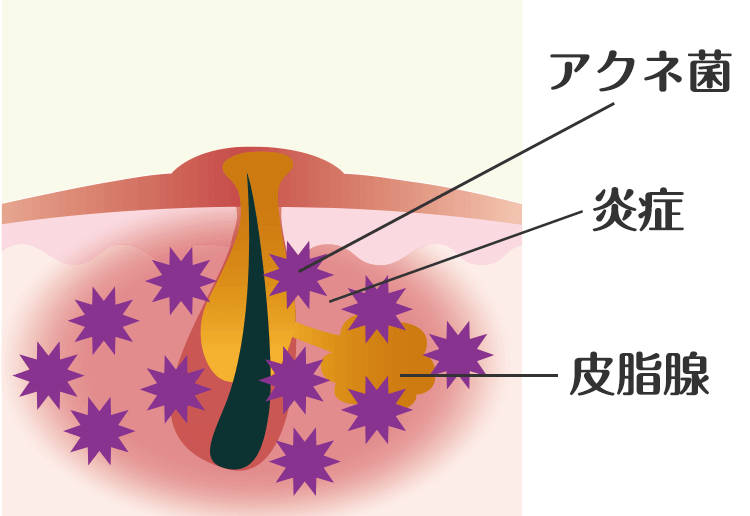 原因③：アクネ菌の繁殖