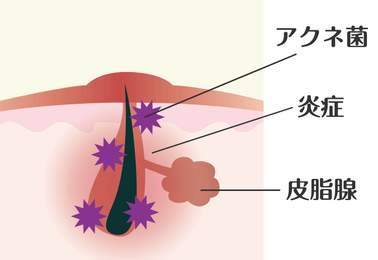 赤ニキビ 毛穴の状態