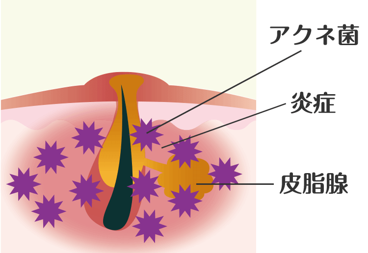 黄ニキビ（化膿ニキビ）