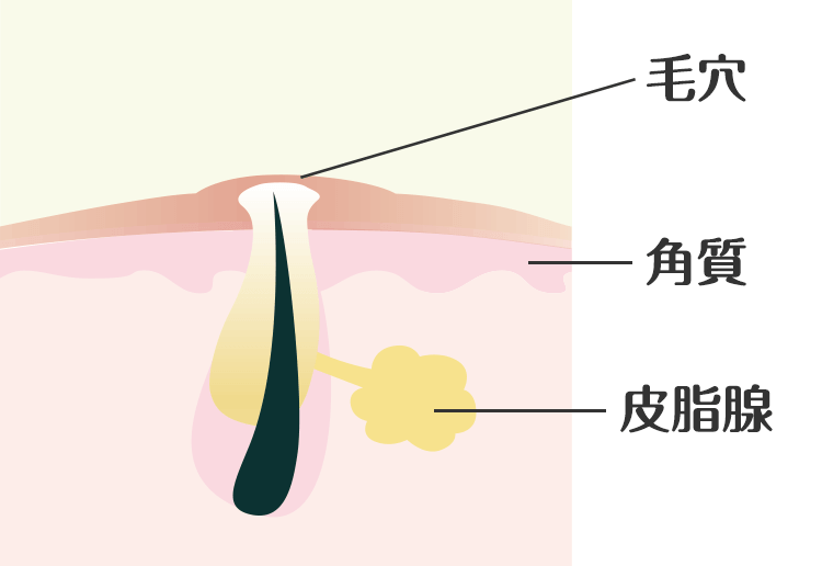 白ニキビ 毛穴の状態