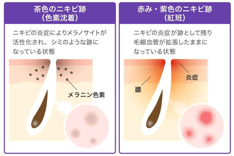 ニキビ跡の色素沈着