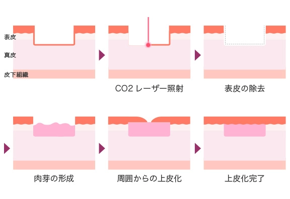 アブレーションとは