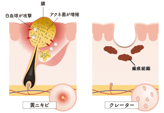 ダーマペンの深度の違い