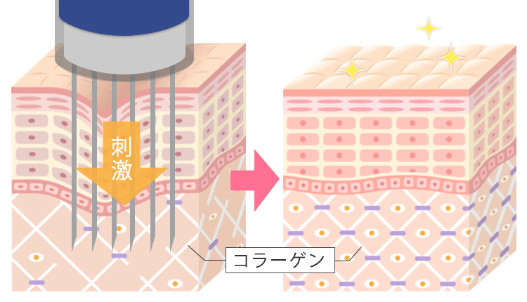 ダーマペンの効果