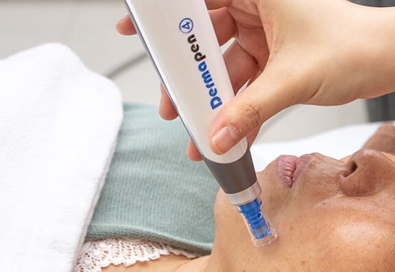 ダーマペン施術