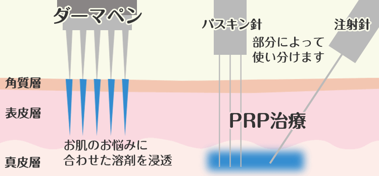 ヴァンパイアプログラムとは