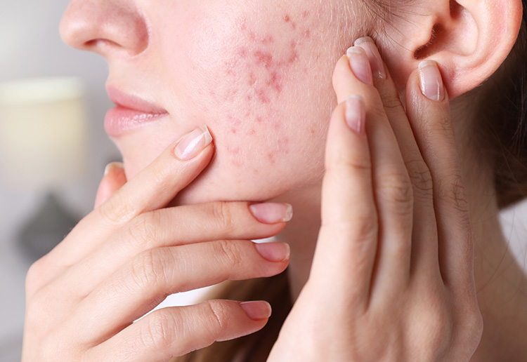 ニキビ跡の凹み（クレーター）