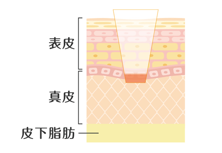 一般的なレーザー