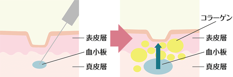 PRP治療(再生治療)の効果