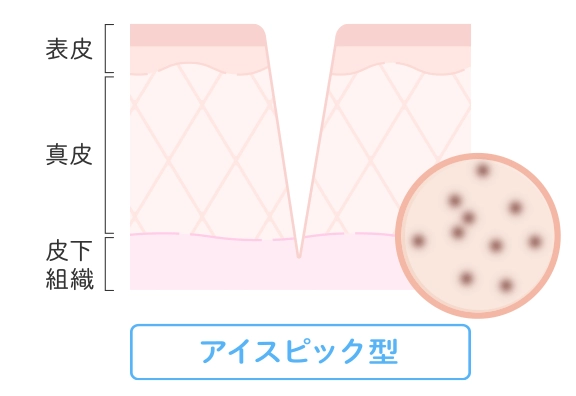 アイスピック型
