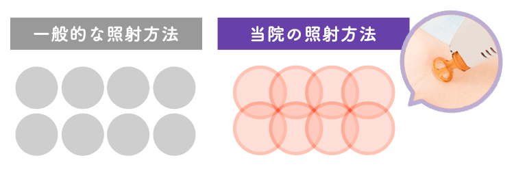 医療レーザーの重ね打ち