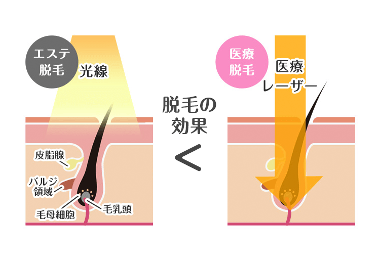 医療脱毛とエステ脱毛の比較（脱毛機器）