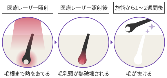 医療脱毛とは?