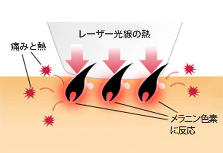 ムダ毛に反応したレーザーが熱を発するため