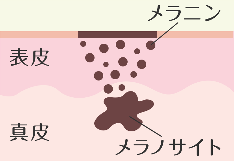 レーザートーニングとは