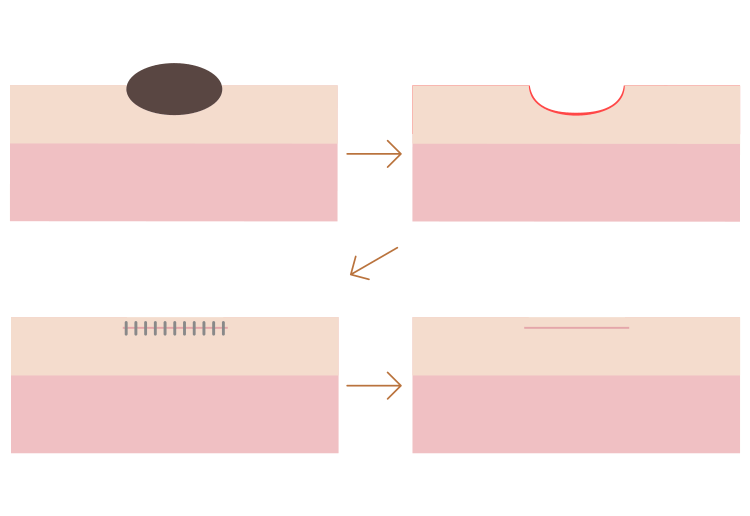 切縫法