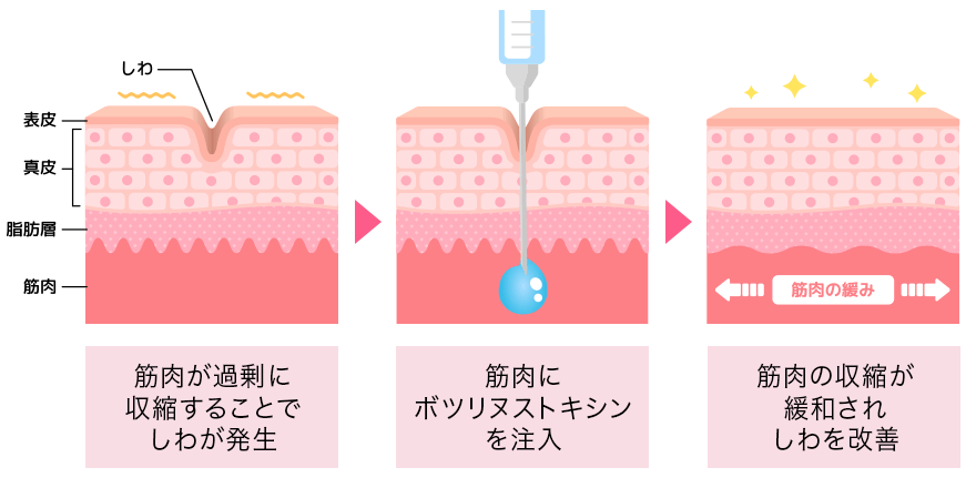 ボトックス注射の効果