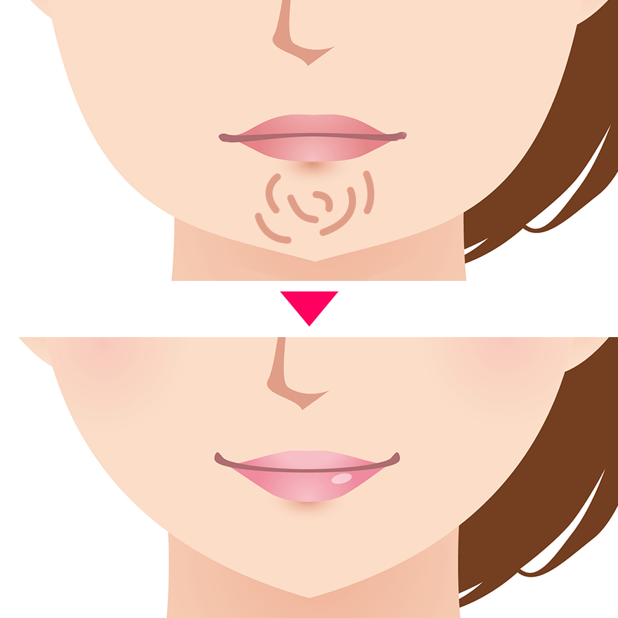 あごの梅干しじわ