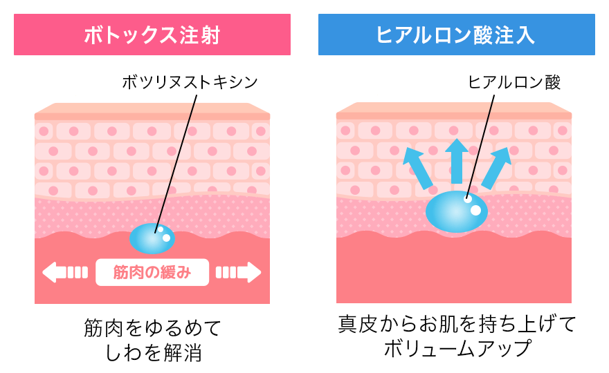 ボトックス注射とヒアルロン酸注射の違い