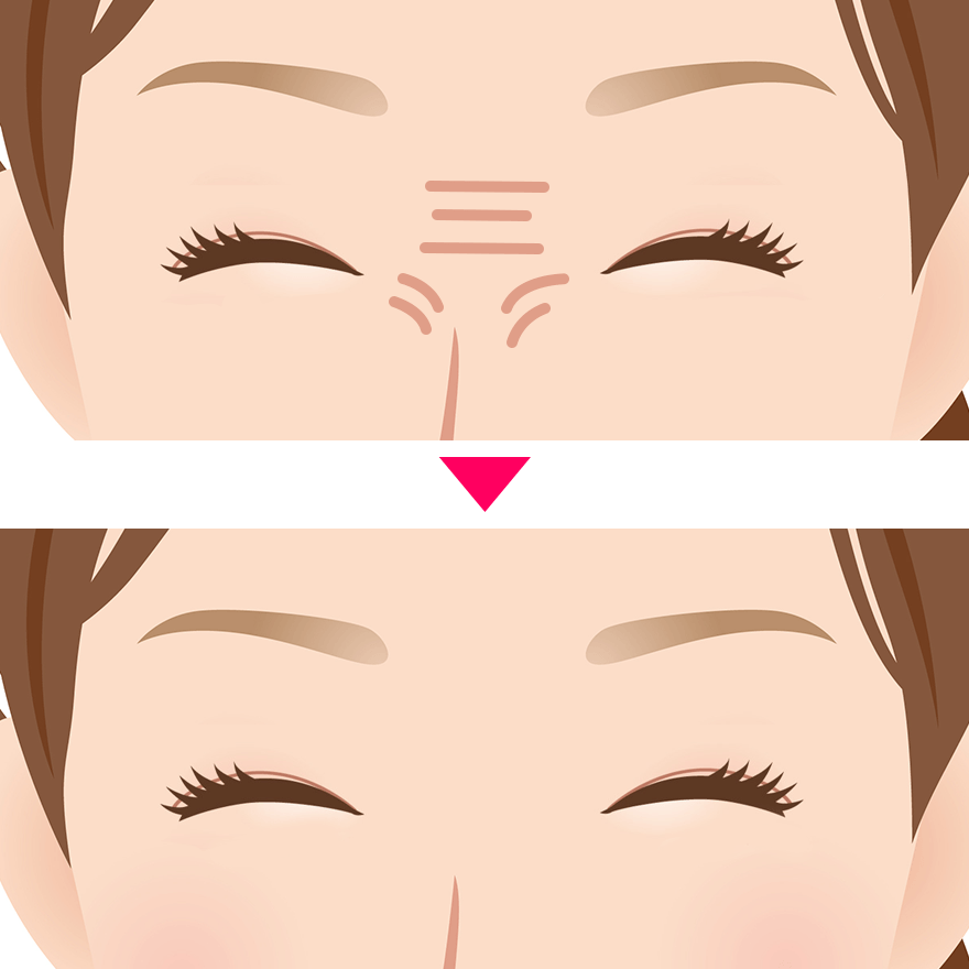 鼻のバニーライン