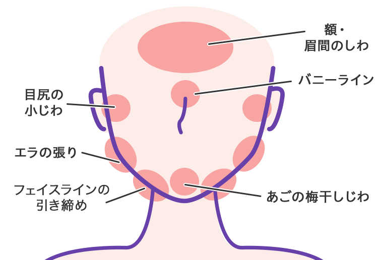 ボトックス注射の有効部位