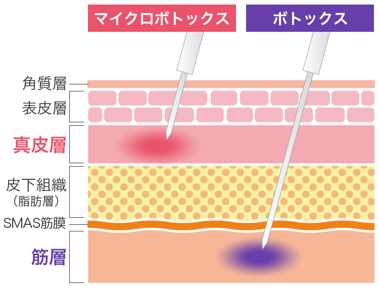ボトックス注射とヒアルロン酸注射の違い