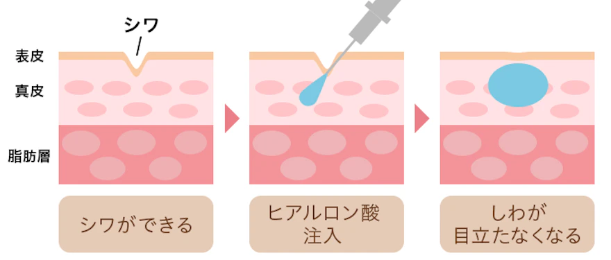 ヒアルロン酸の効果