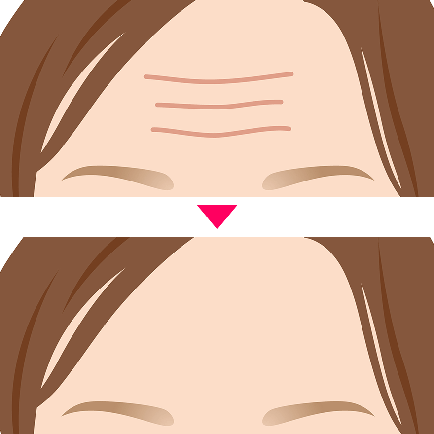 しわ・たるみの改善