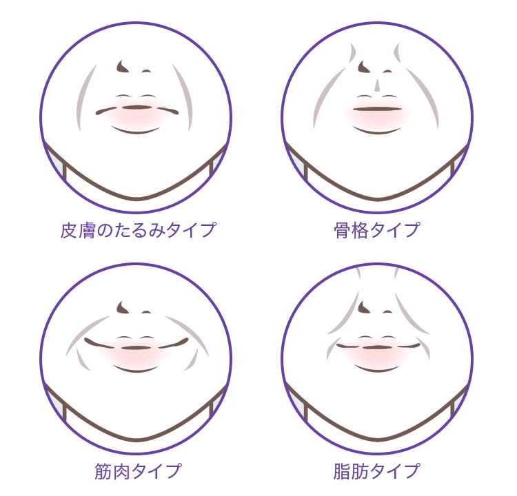 ほうれい線のタイプは4種類