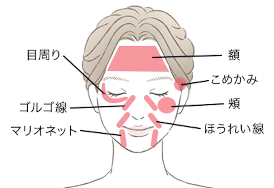 ボリフトおすすめの注入部位