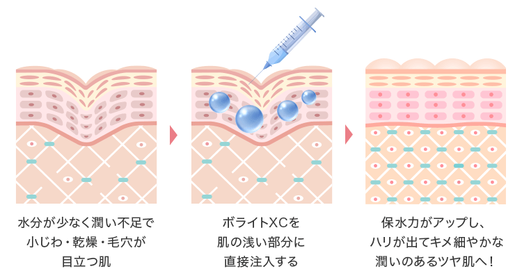 ジュビダームビスタ&#174;ボライトXCとは？