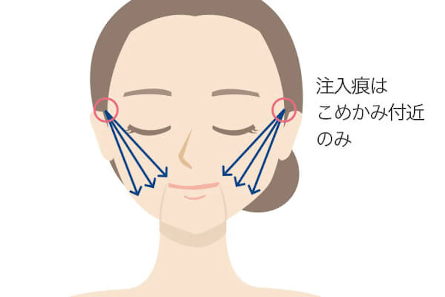 「たるみ」に向いている理由