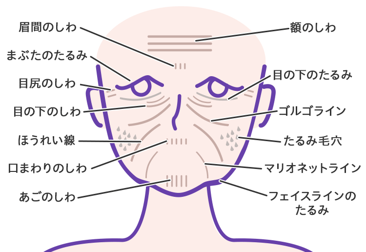 しわ・たるみの種類