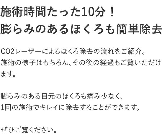 施術時間たった10分!膨らみのあるほくろも簡単除去
